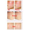 BELULU For Acne Аппарат световой терапии при акне